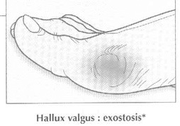 HALLUX VALGUS, косточки, шишки на ногах, молоткообразная деформация пальцев, натоптыши, мозоли на ноге