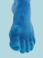 HALLUX RIGIDUS (ригидный первый палец стопы), артроз первого плюснефалангового сустава