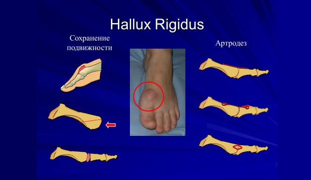HALLUX RIGIDUS (ригидный первый палец стопы), артроз первого плюснефалангового сустава