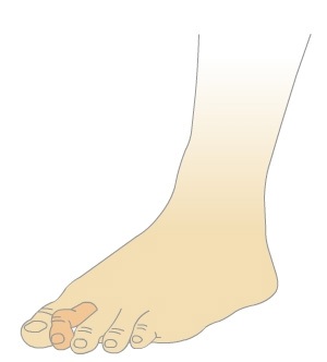 Молоткообразная деформация пальцев, натоптыши, мозоли на ноге